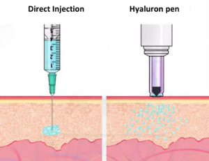 Direct injection and Hyaluron Pen into Skin