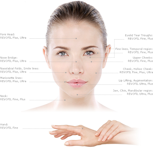 Revofil dermal fillers application